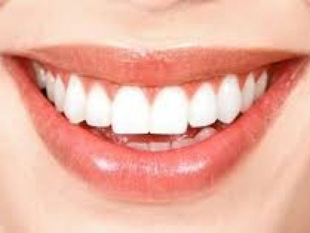 3. Dentes saudáveis precisam ser branquíssimos